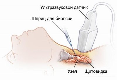 Схема биопсии