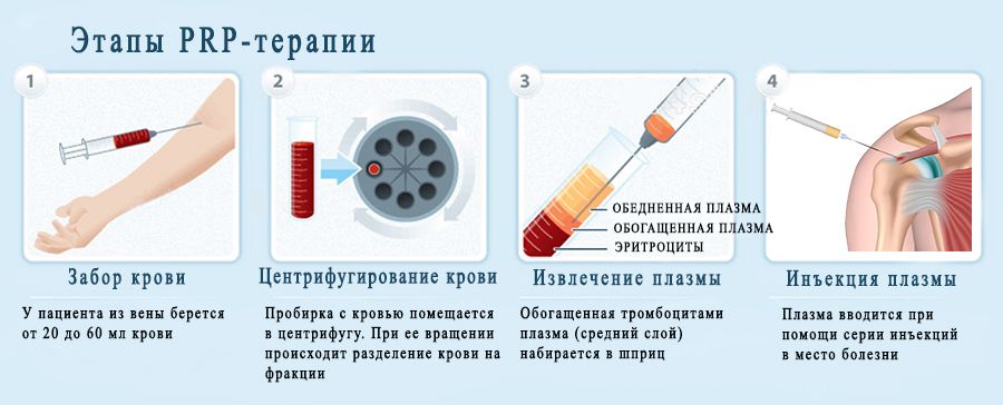 схема процедуры